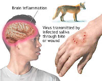 Brain Inflammation1