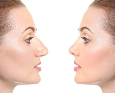 What is Rhinoplasty-note the difference