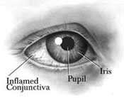  Konjungtivitis Alergika yaitu suatu peradangan alergi pada konjungtiva   Konjungtivitis Alergika