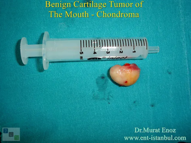 Chondroma in the mouth,Oral STCs,Chondromas,Benign cartilage tumor of the mouth,