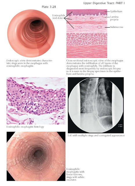 Eosinophilic Esophagitis