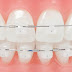 Răng như thế nào được gọi là răng khểnh?