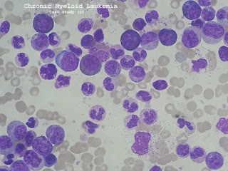 Case Study (2)- Chronic Myeloid Leukemia (CML)