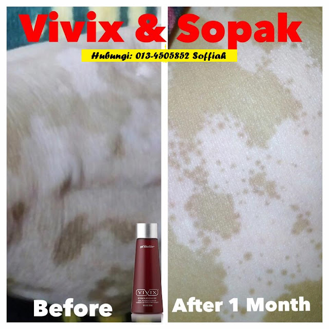 ubat sembuhkan vitiligo dengan cepat