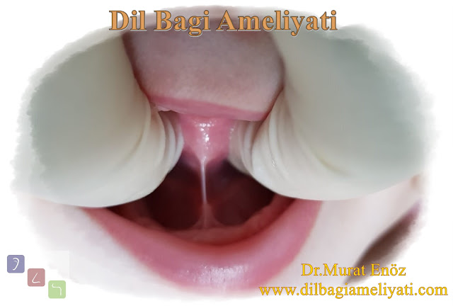 Dil altı bağı ameliyatı - Dil bağı ameliyatı nasıl yapılır? - Dil bağı nasıl kesilir? - Dil bağı kesilmesi - Lingual frenektomi - Hipertrofik lingual frenulum plastiği