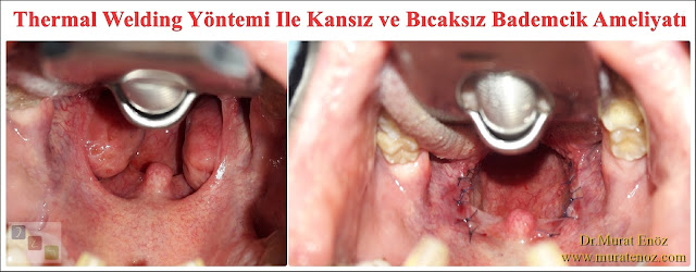 Bademcik taşı tedavisi - Uyku apnesi tedavisi - Magma tedavisi - Kansız bademcik ameliyatı - İri bademcik tedavisi - Thermal welding tonsillectomy - Tonsillectomy in Istanbul - Tonsil removal in Istanbul - Bloodless, knifeless, painless tonsillectomy in Istanbul