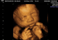 3d Ultrasound5