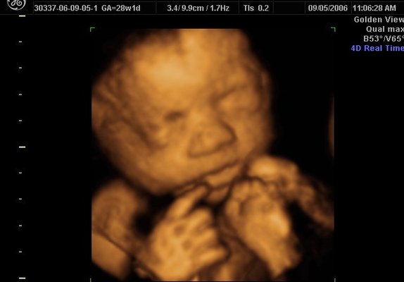 3d Ultrasound5