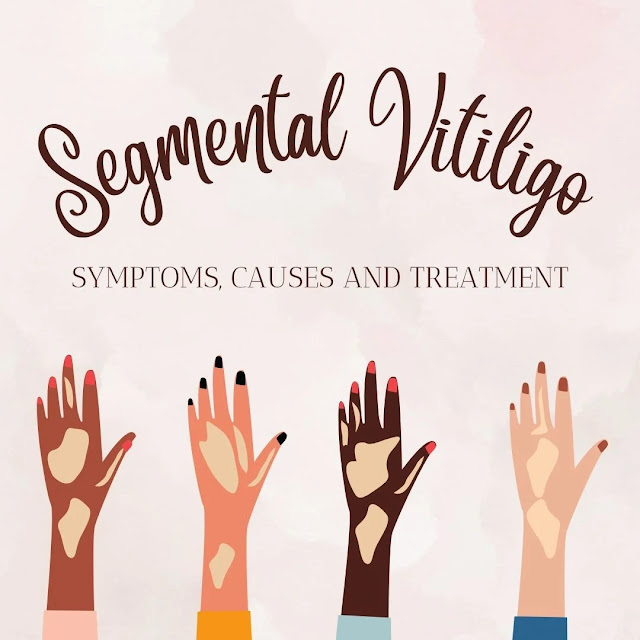 vitiligo segmental pattern, segmental vitiligo prognosis, vitiligo surgery, non segmental vitiligo treatment, segmental, vitiligo symptoms, segmental vitiligo vs non segmental, segmental vitiligo repigmentation