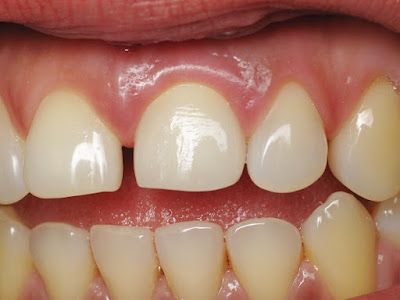 Trường hợp nào nên bọc răng sứ titan? 
