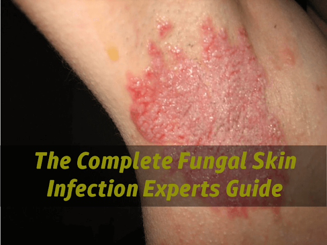 Fungal infection types and increase in its cases during summers