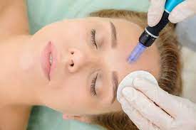 Microneedling Liverpool