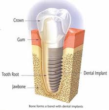 Dental implant Arizona