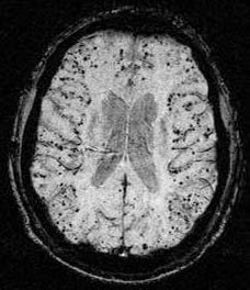 Magnetic Resonance Innovations Research Blog: Cerebral Microbleeds in