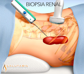 Nefrologia en Guadalajara.Biopsia renal
