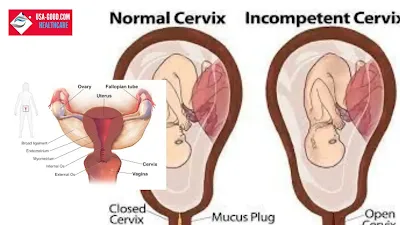 What is Incompetent Cervix?