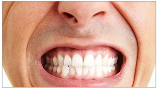 Close-up photo of a man showing his teeth that are clenched together