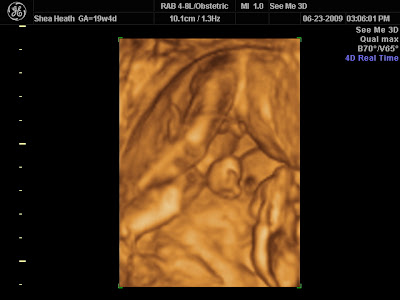 3d ultrasound pictures of twins. 3d ultrasound pictures at 19