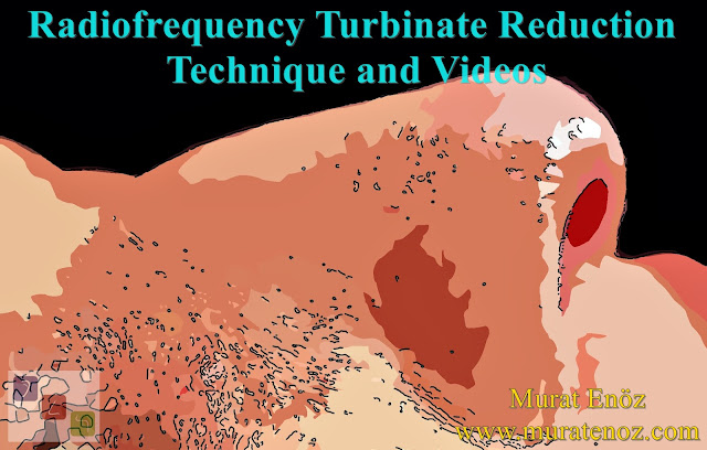 Radiofrequency Turbinate Reduction Technique - Radiofrequency Turbinate Reduction Videos - Turbinate Radiofrequency Video - Turbinate Reduction Video