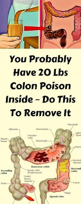 You Probably Have 20 Lbs Colon Poison Inside– Do This To Remove it!!!!!
