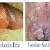 Gejala dan Pengobatan Condyloma Acuminata