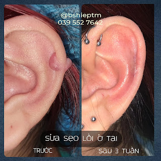 Điều trị sẹo lồi ở tai sau xỏ khuyên tai 1 năm