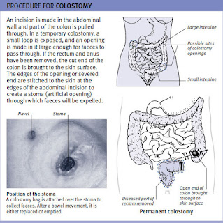 colostomy