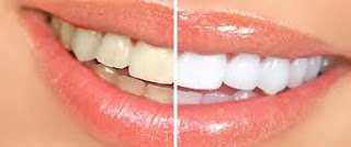 teeth-whitening-pen