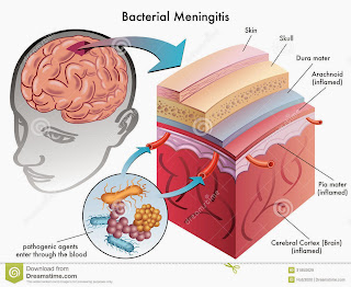 Resultado de imagen para Meningitis