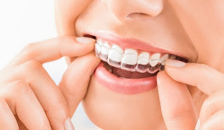 ما هو العمر الأنسب لتبييض الأسنان