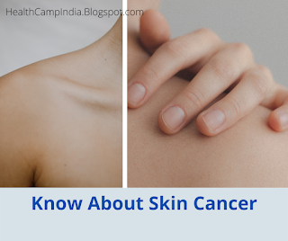 Know About Skin Cancer