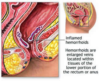 Acute Pain related to Hemorrhoids