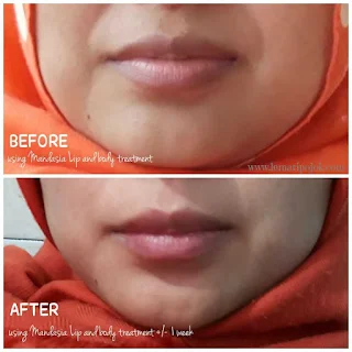 bEFORE DAN AFTER PEMAKAIAN MANDASIA LIP AND BODY TREATMENT BALM PADA BIBIR KURANG LEBIH 1 MINGGU