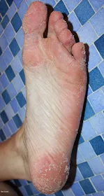 pied qui pèle baby foot