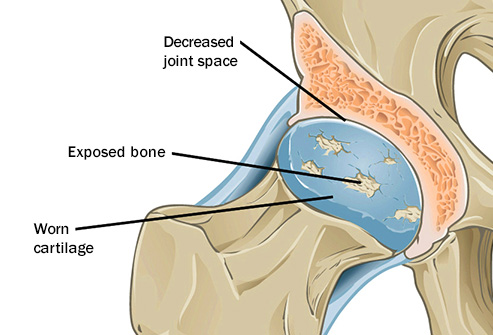 Osteoartritis