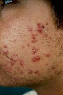 Acne Vulgaris