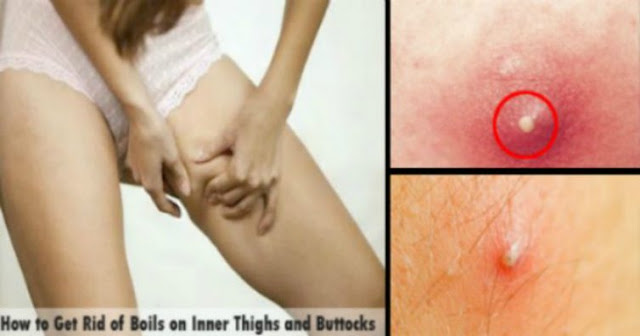  Easy Home Remedies For Boils On Thighs And Buttocks