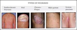 psoriasis