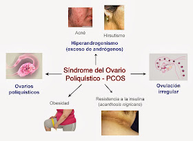 Síntomas del Síndrome del Ovario Poliquístico