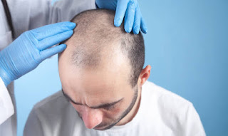 Hair Transplant Cost in Turkey