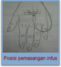 Posisi pemasangan infus
