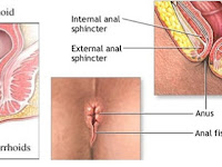 Gejala Ambeien Dan Cara Mengatasi