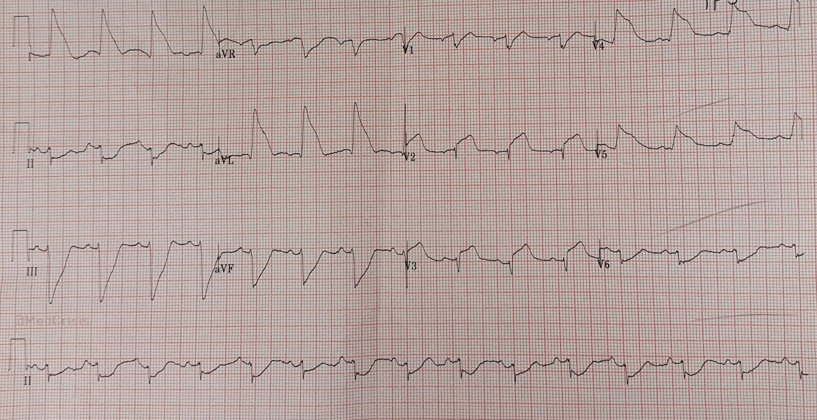 Dr Smith S Ecg Blog Shark Fin Ecg In I Avl V4 And V5 Which