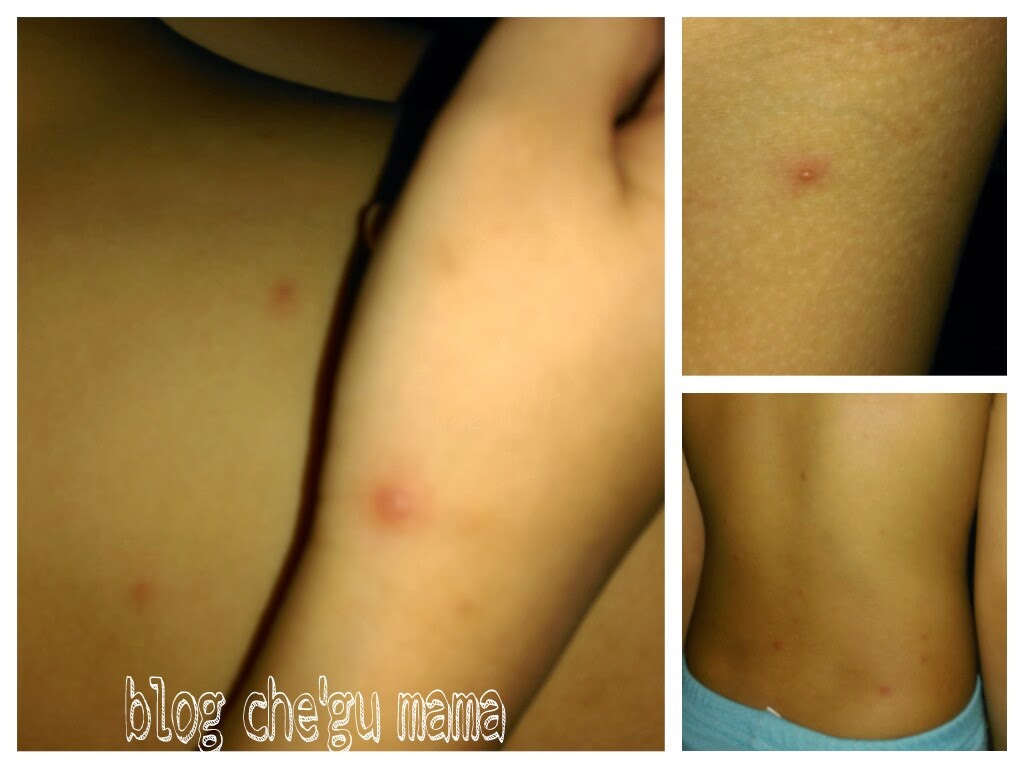 ini BeLOg Che' Gu MaMa...: CHICKENPOX SEWAKTU MENGANDUNG ...