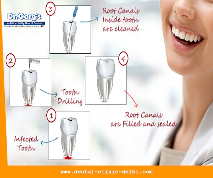 How to Get Root Canal Treatment in India?