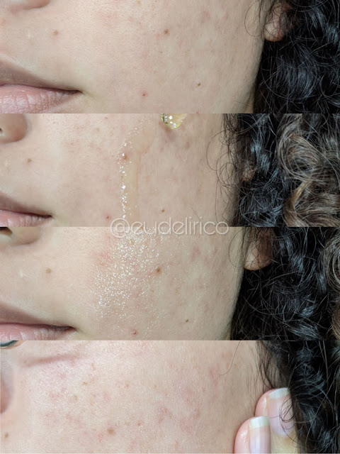 Óleo Facial 3 em 1 Pró da Max Love pele com acne pele com espinhas antes e depois