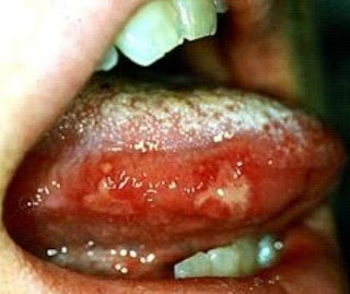 Rashes and blisters and inside of mouth and on the tounge caused by coxsackieviruses and other enteroviruses disease pictures