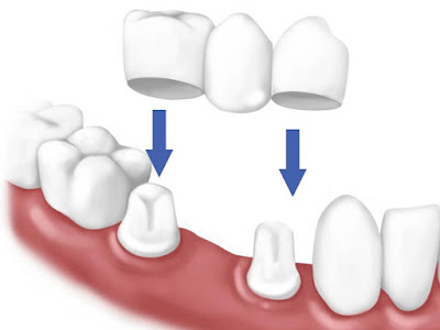 Quy trình làm cầu răng sứ diễn ra như thế nào? 