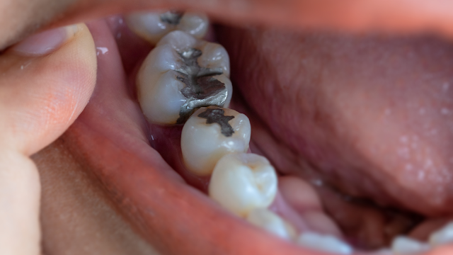 Infection after dental implants treatment
