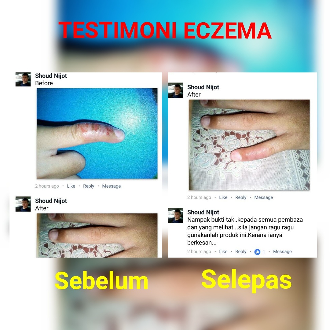 KRIM GATAL KULIT HERBA RERAMA :- Merawat Masalah Gatal² 